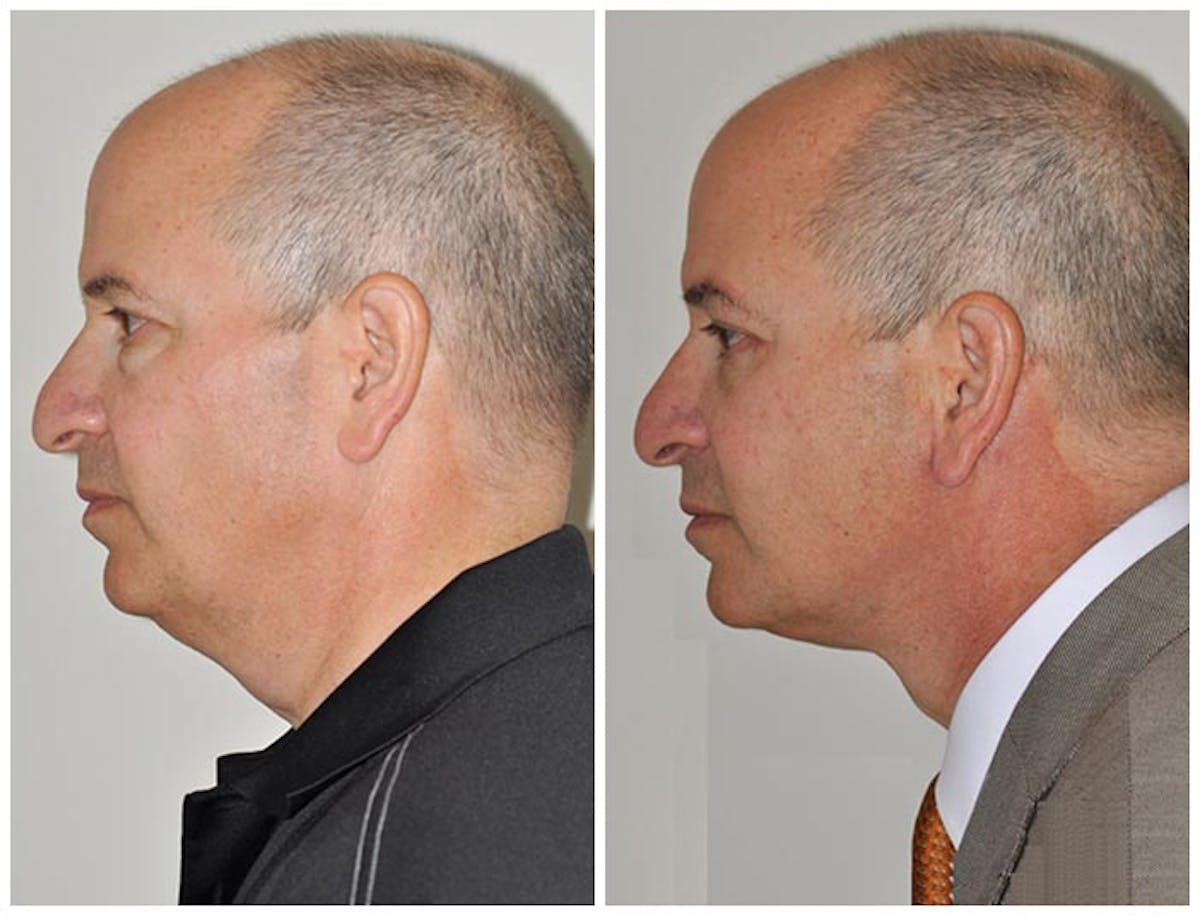 Neck Lift Before & After Gallery - Patient 102863 - Image 1