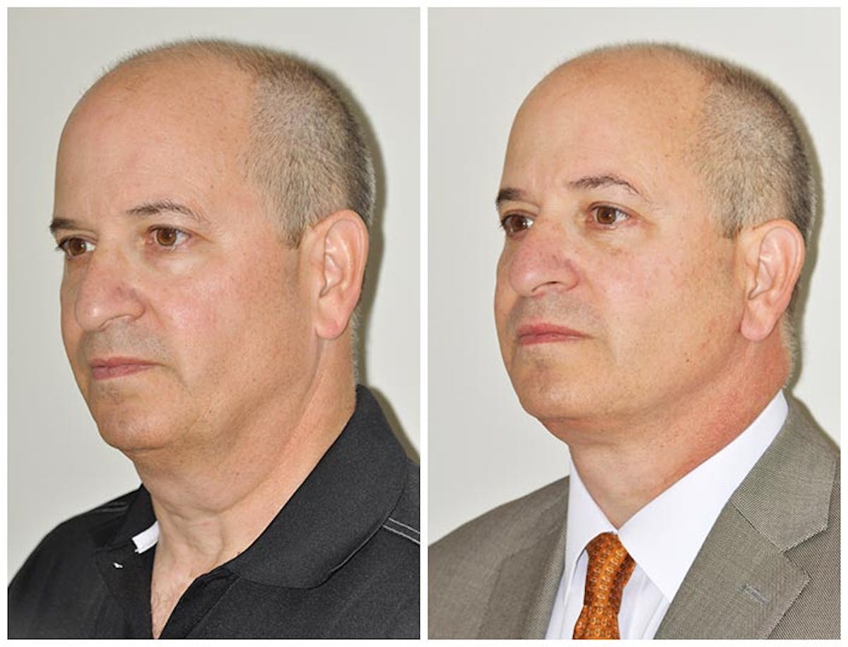 Neck Lift Before & After Gallery - Patient 102863 - Image 2