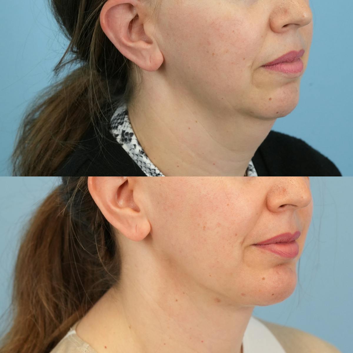 Chin Implants Before & After Gallery - Patient 318506 - Image 4
