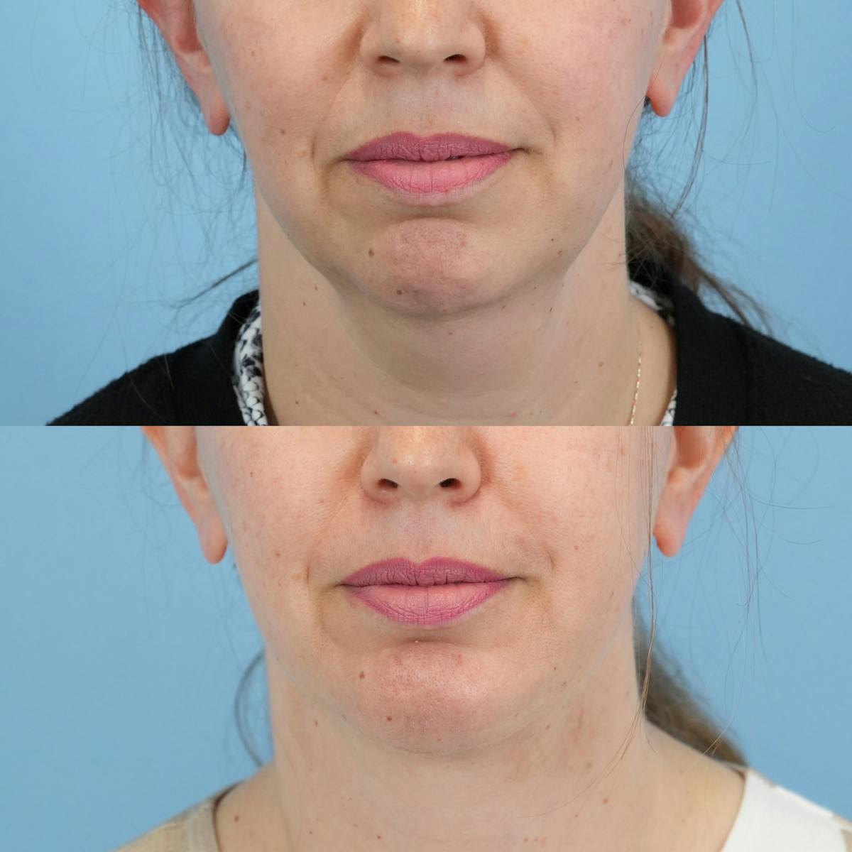 Chin Implants Before & After Gallery - Patient 318506 - Image 3