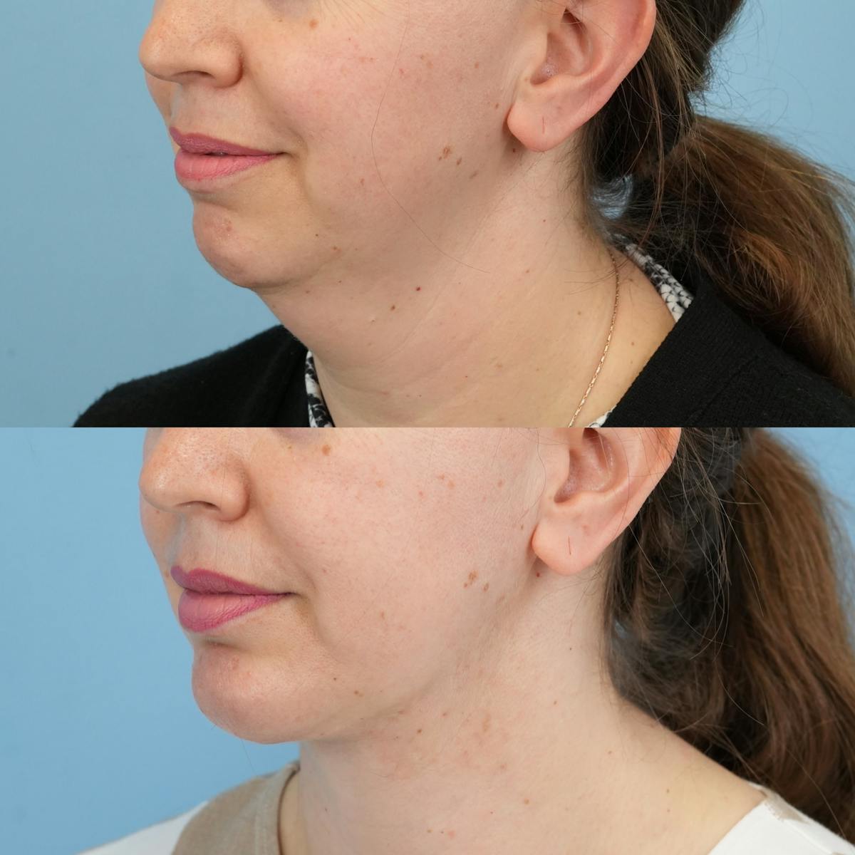 Chin Implants Before & After Gallery - Patient 318506 - Image 2