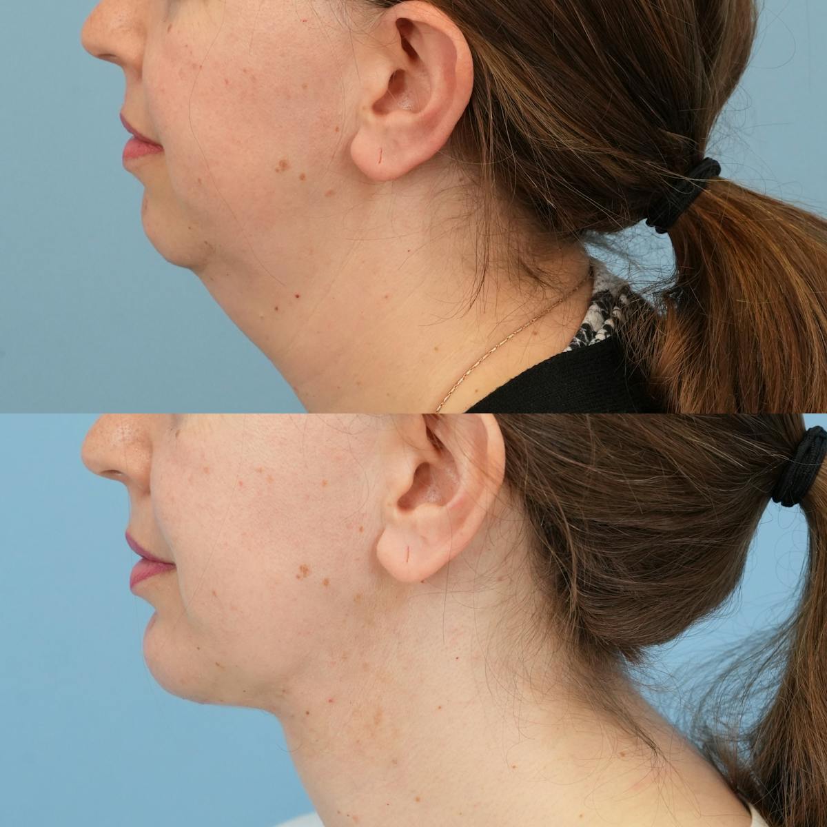 Chin Implants Before & After Gallery - Patient 318506 - Image 1