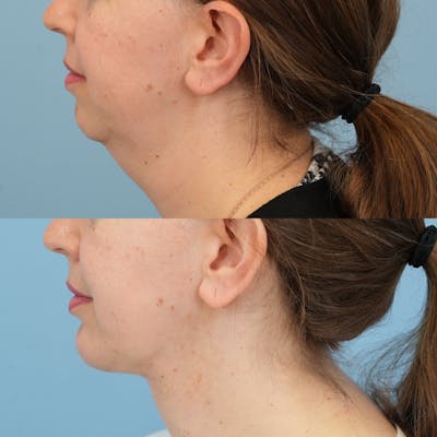 Chin Implants Before & After Gallery - Patient 318506 - Image 1