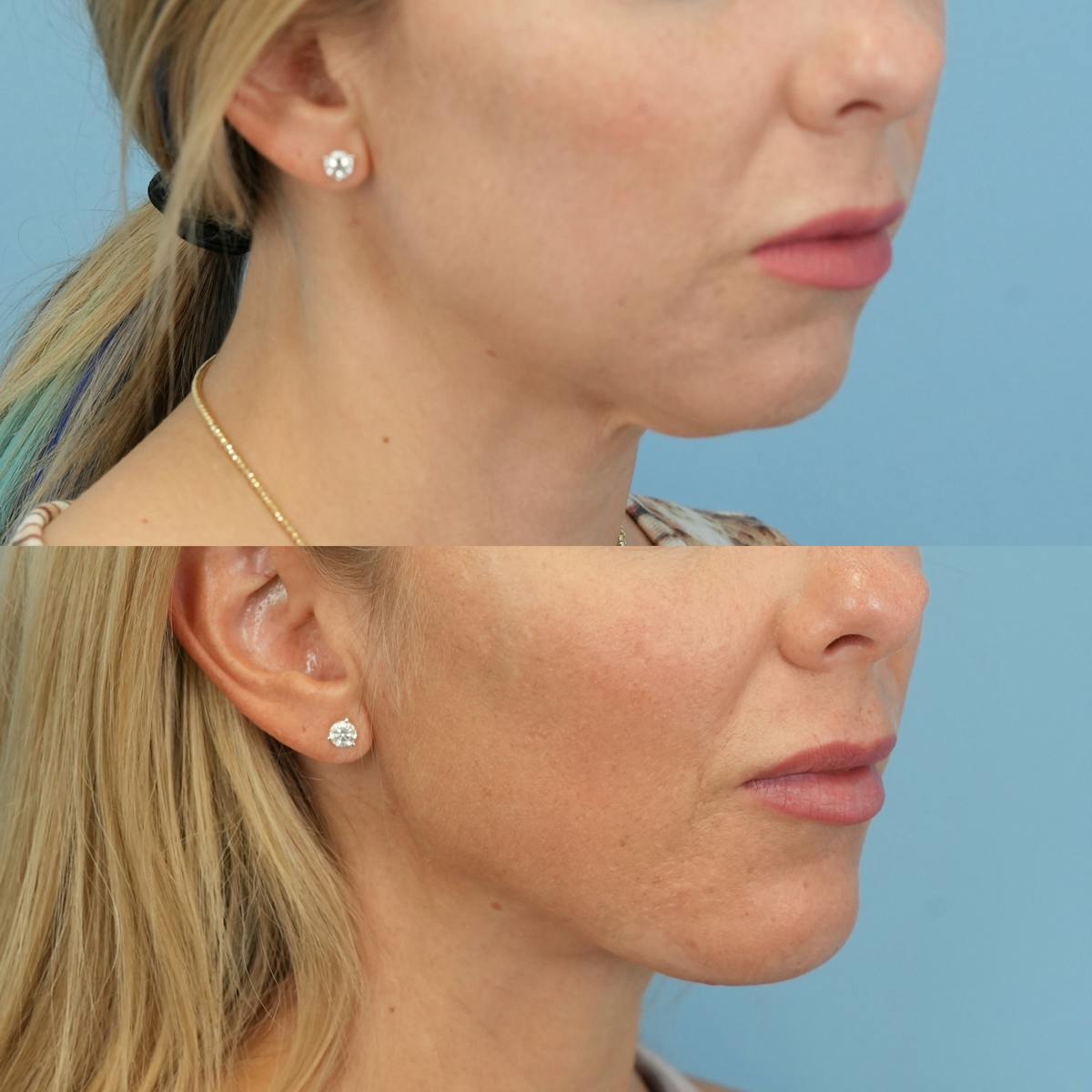 Chin Implants Before & After Gallery - Patient 588562 - Image 4