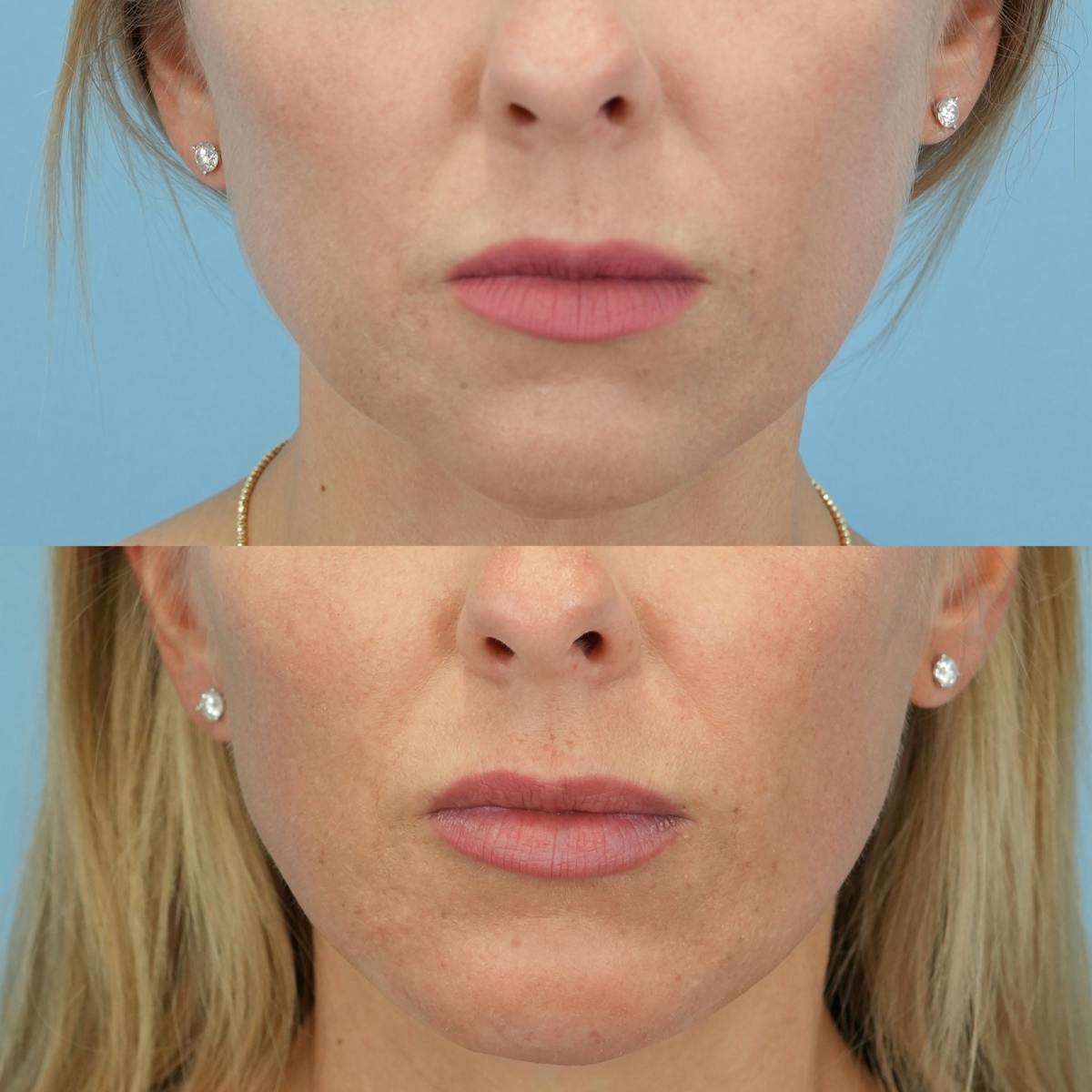 Chin Implants Before & After Gallery - Patient 588562 - Image 3