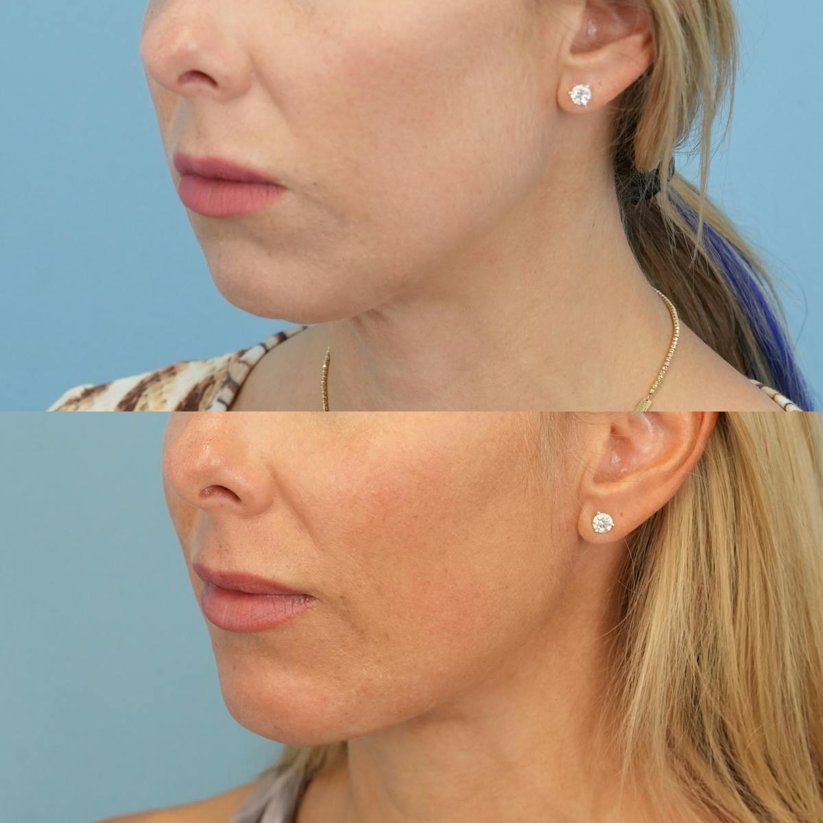 Chin Implants Before & After Gallery - Patient 588562 - Image 2