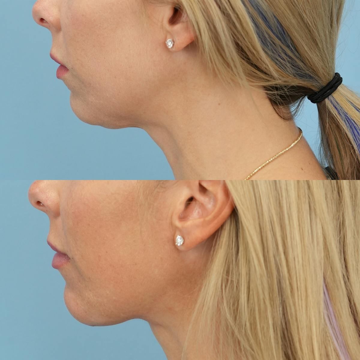 Chin Implants Before & After Gallery - Patient 588562 - Image 1