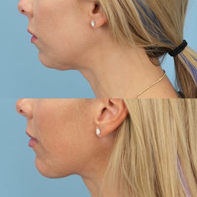 Chin Implants Before & After Gallery - Patient 588562 - Image 1