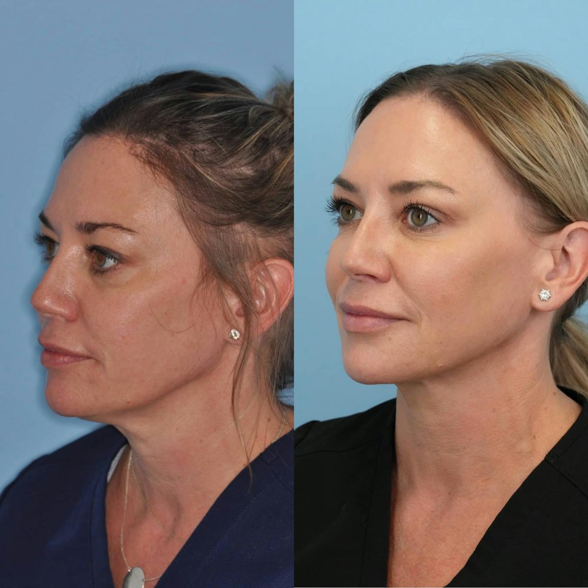 Neck Liposuction Before & After Gallery - Patient 152795 - Image 2