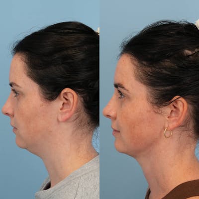 Neck Liposuction Before & After Gallery - Patient 388013 - Image 1
