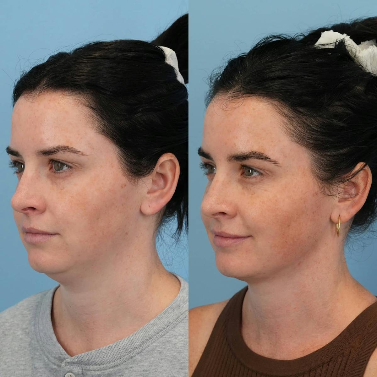 Neck Liposuction Before & After Gallery - Patient 388013 - Image 2