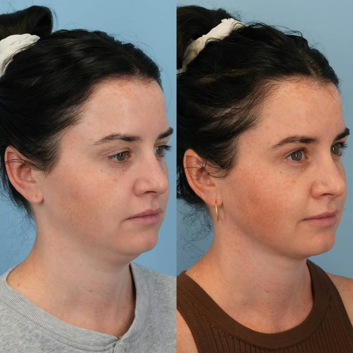 Neck Liposuction Before & After Gallery - Patient 388013 - Image 4