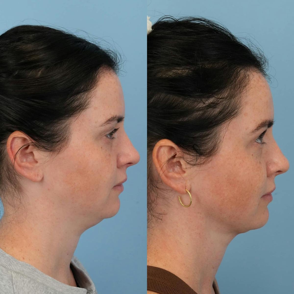 Neck Liposuction Before & After Gallery - Patient 388013 - Image 5
