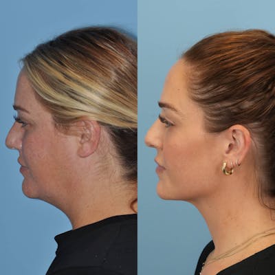 Neck Liposuction Before & After Gallery - Patient 280259 - Image 1