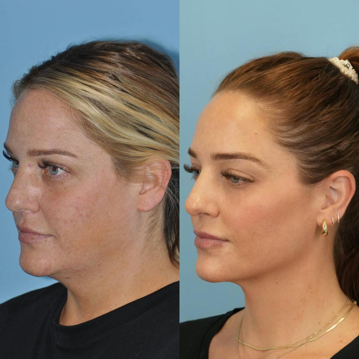 Neck Liposuction Before & After Gallery - Patient 280259 - Image 2