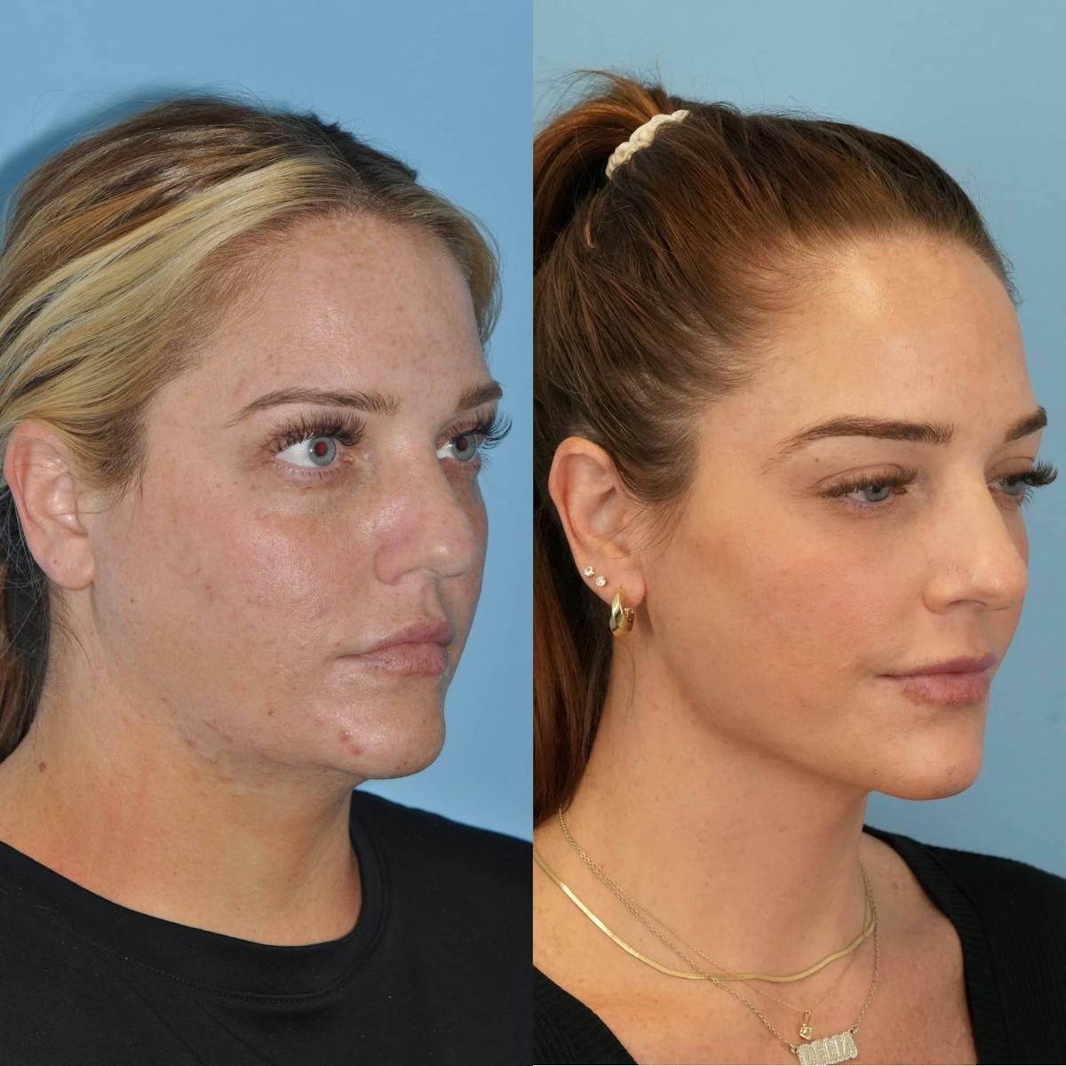 Neck Liposuction Before & After Gallery - Patient 280259 - Image 4