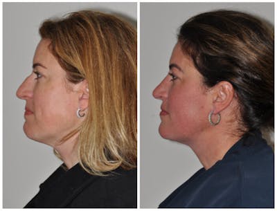 Neck Liposuction Before & After Gallery - Patient 290253 - Image 1