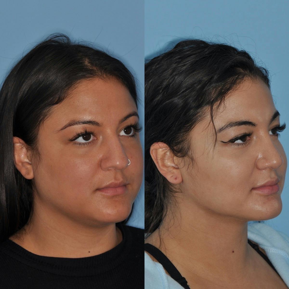 Neck Liposuction Before & After Gallery - Patient 417476 - Image 2