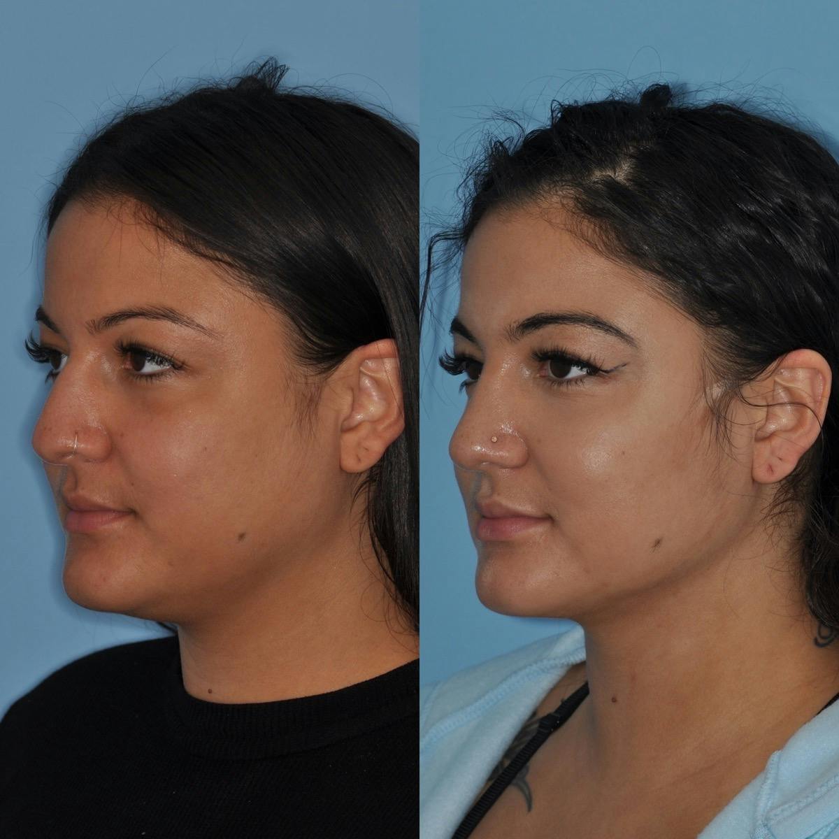 Neck Liposuction Before & After Gallery - Patient 417476 - Image 3