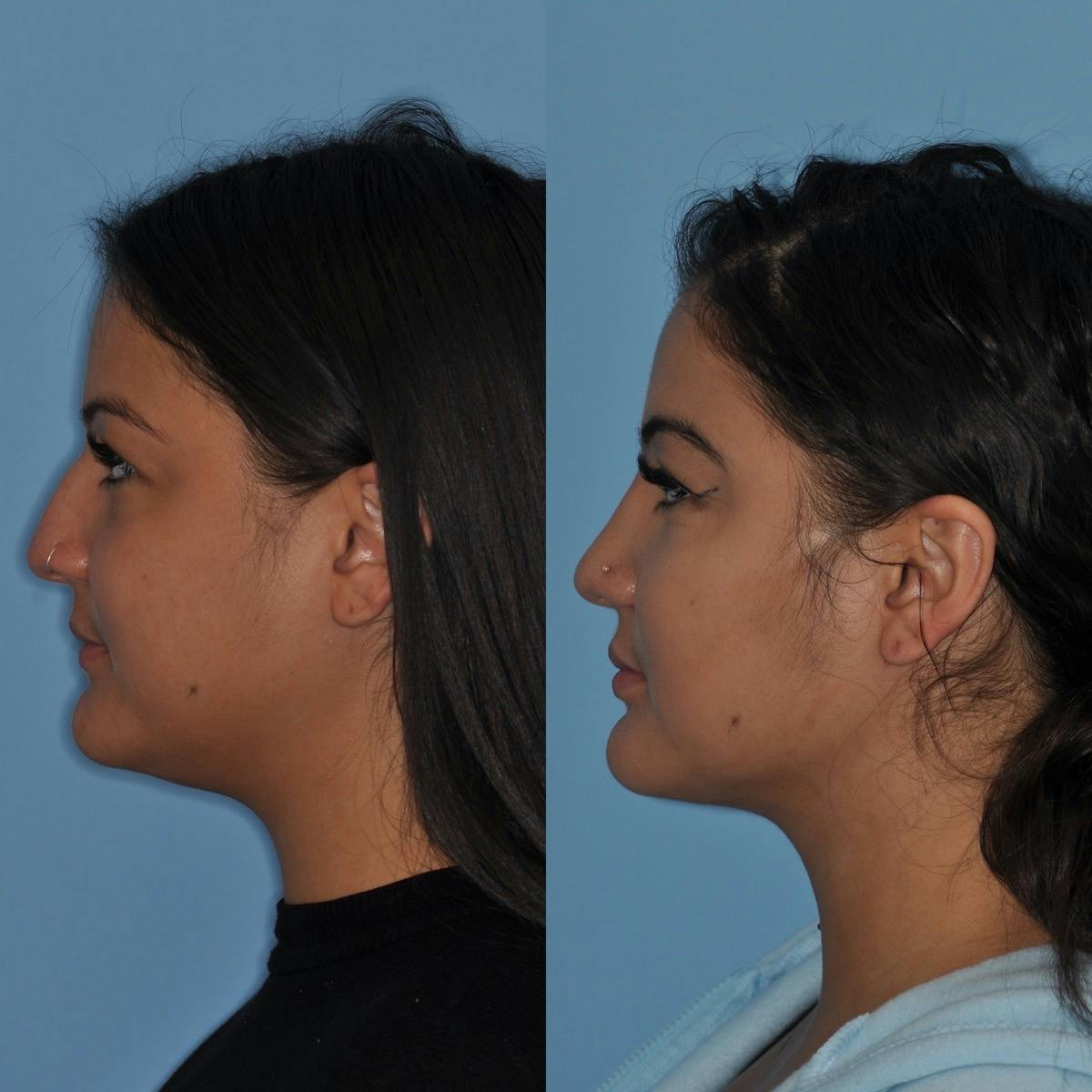 Neck Liposuction Before & After Gallery - Patient 417476 - Image 4