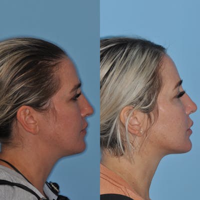 Neck Liposuction Before & After Gallery - Patient 163502 - Image 1
