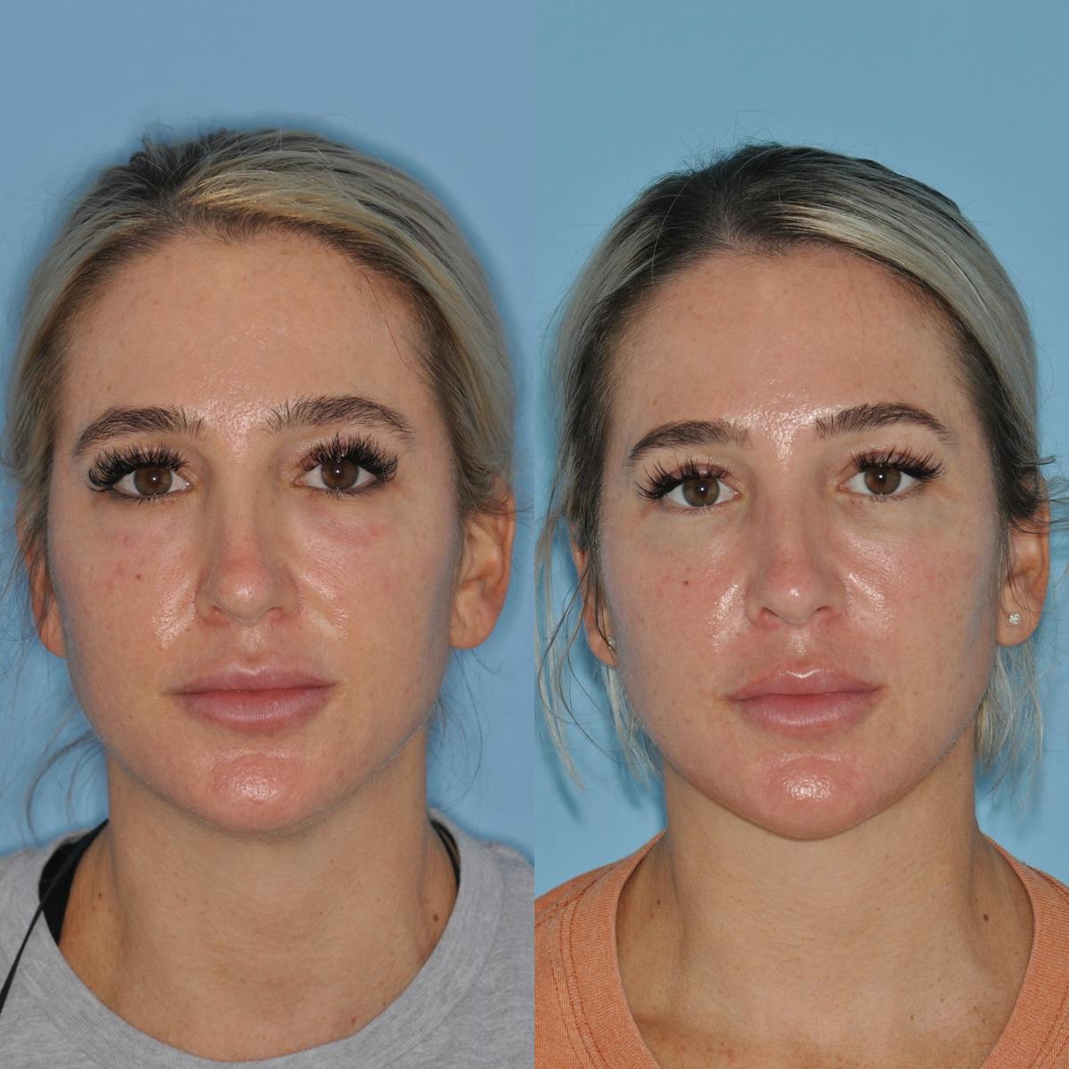 Neck Liposuction Before & After Gallery - Patient 163502 - Image 3