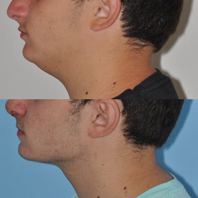 Neck Liposuction Before & After Gallery - Patient 347237 - Image 1