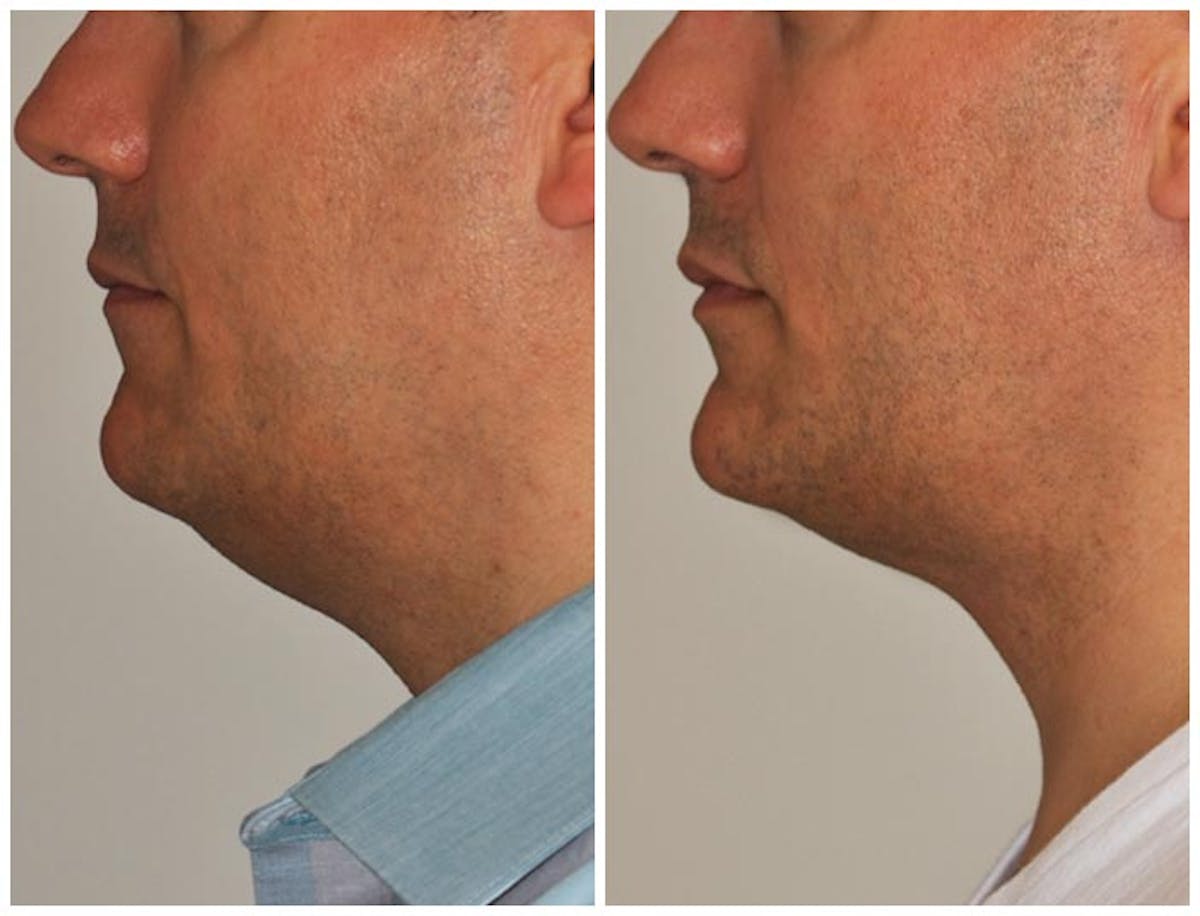 Neck Liposuction Before & After Gallery - Patient 386807 - Image 1