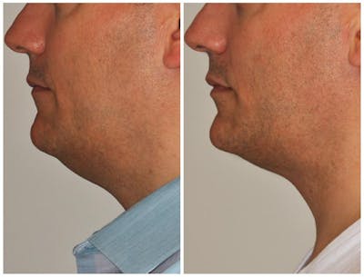 Neck Liposuction Before & After Gallery - Patient 386807 - Image 1
