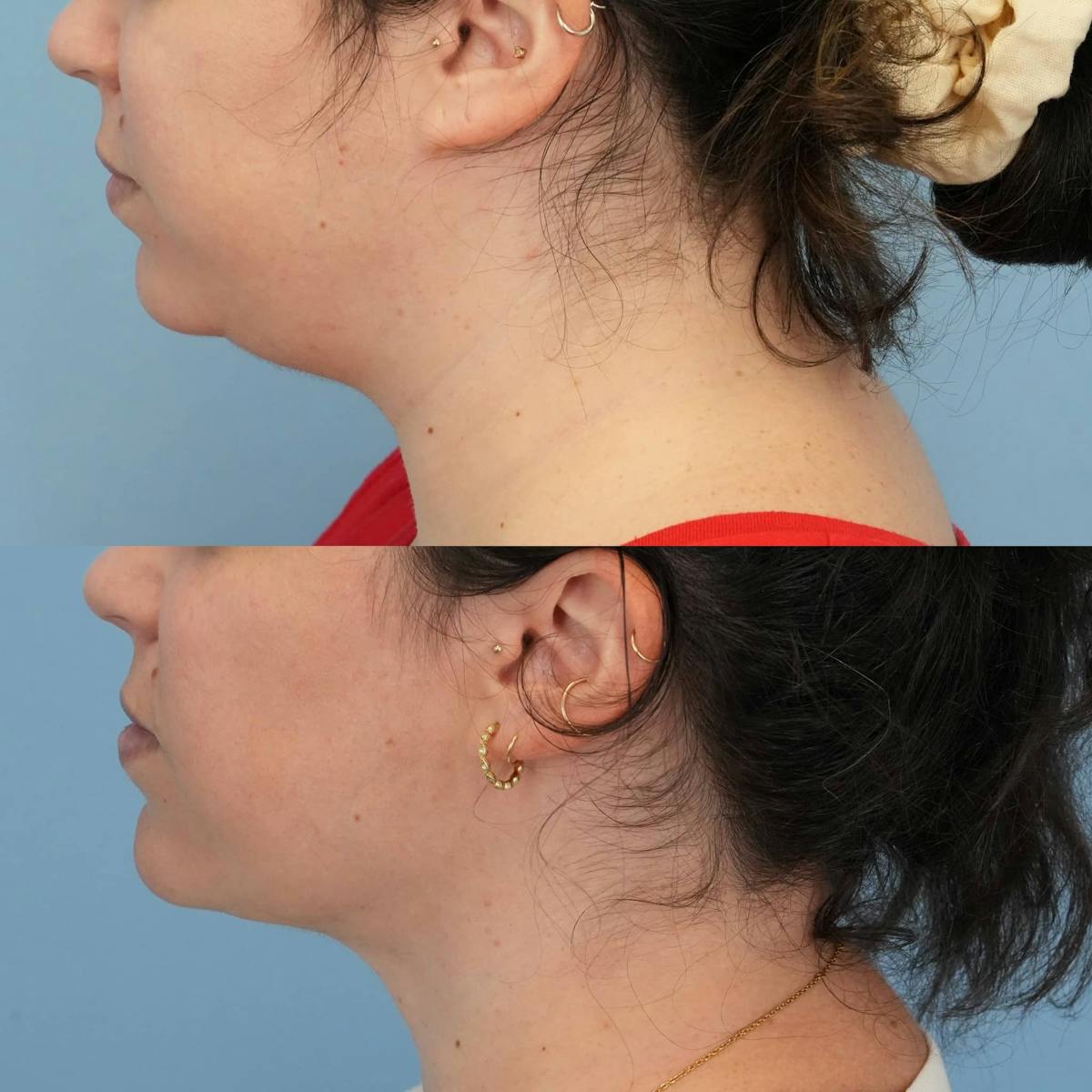 Neck Liposuction Before & After Gallery - Patient 295676 - Image 1