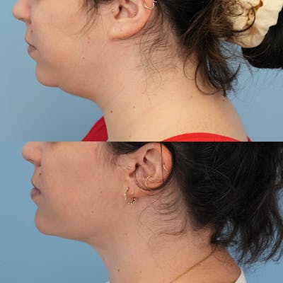Neck Liposuction Before & After Gallery - Patient 295676 - Image 1