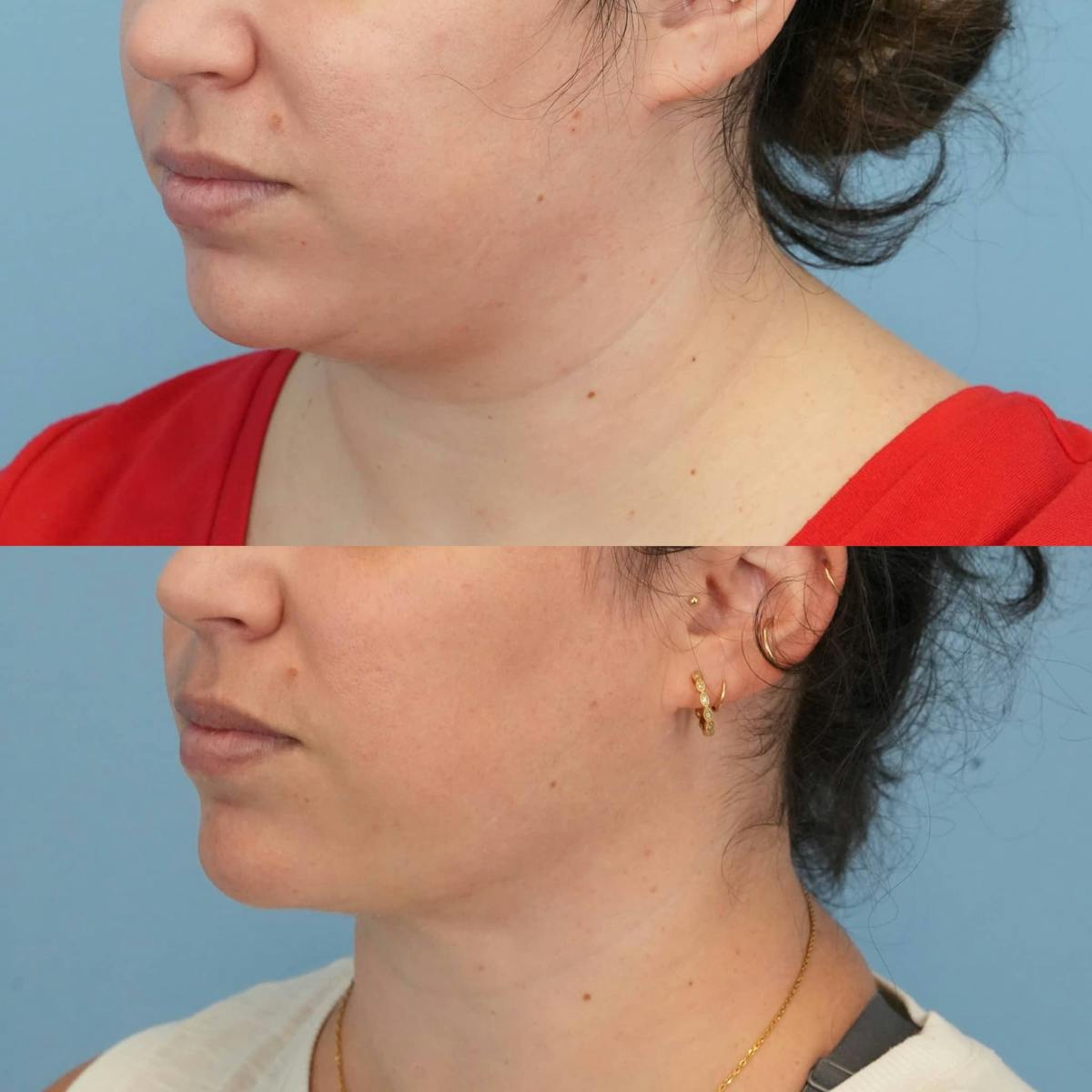Neck Liposuction Before & After Gallery - Patient 295676 - Image 4
