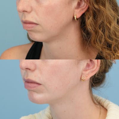 Buccal Fat Excision Before & After Gallery - Patient 335115 - Image 1