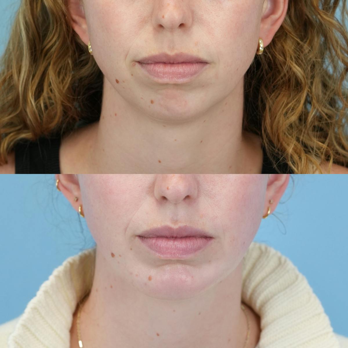 Buccal Fat Excision Before & After Gallery - Patient 335115 - Image 2