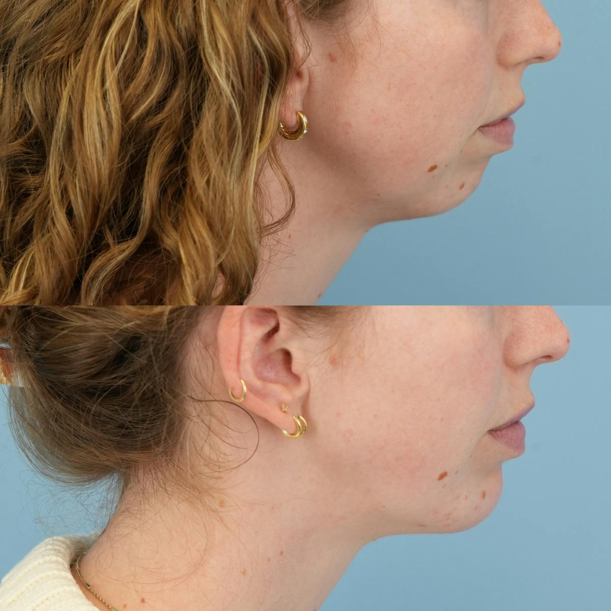 Buccal Fat Excision Before & After Gallery - Patient 335115 - Image 4