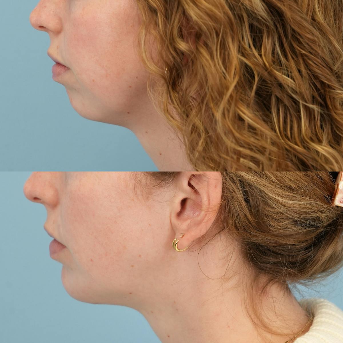 Buccal Fat Excision Before & After Gallery - Patient 335115 - Image 5