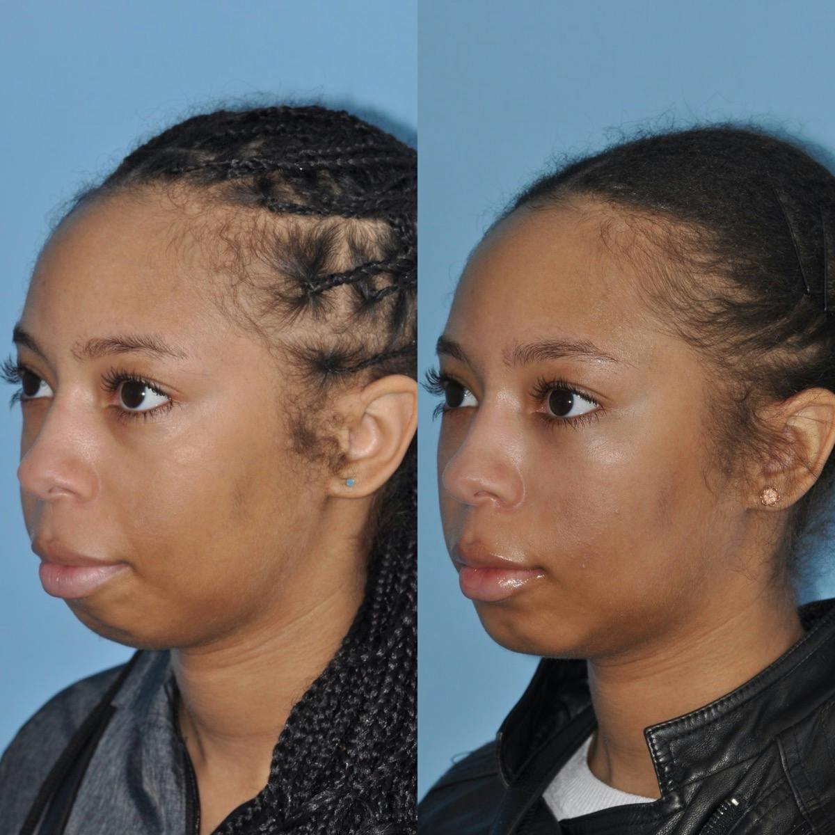 Buccal Fat Excision Before & After Gallery - Patient 163084 - Image 1