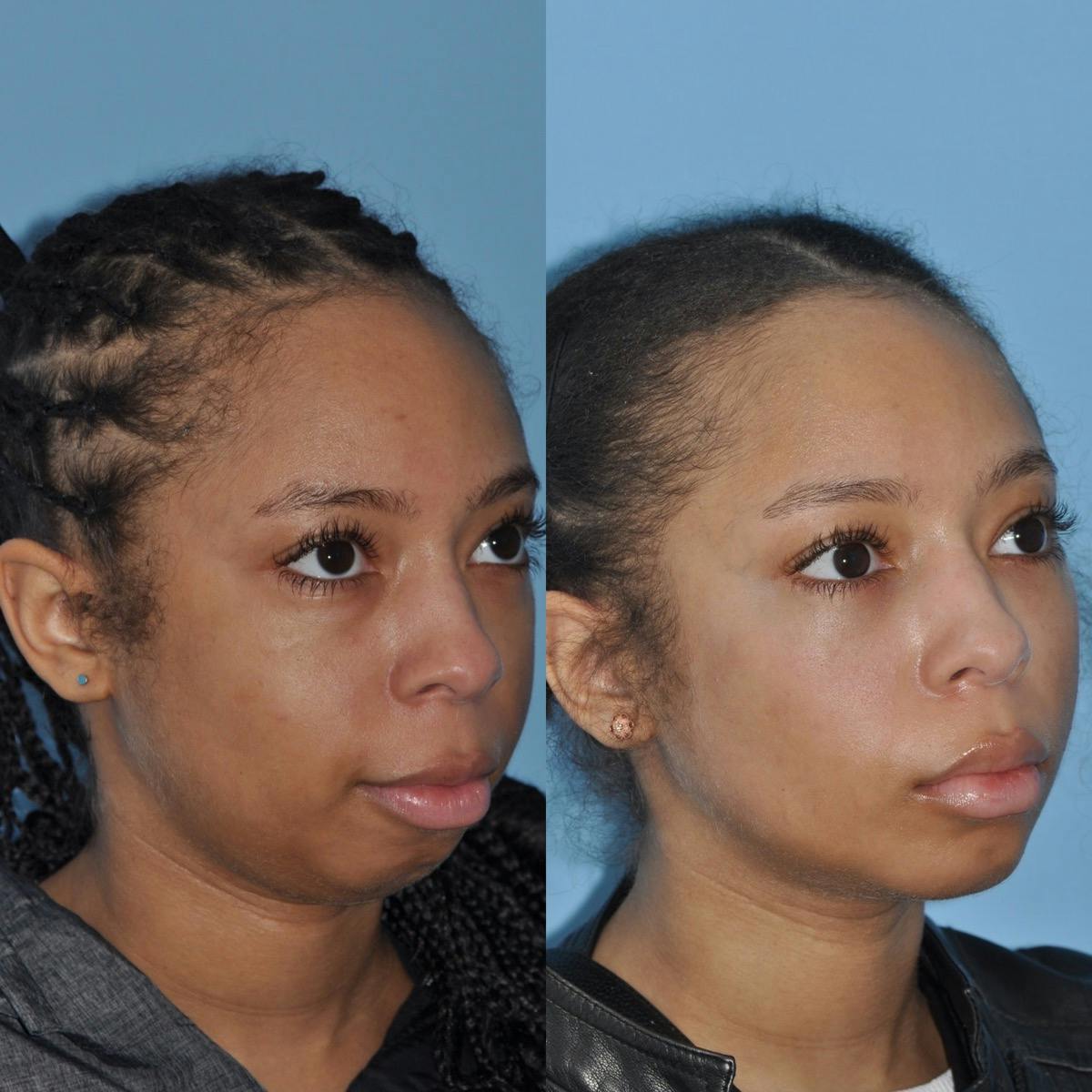 Buccal Fat Excision Before & After Gallery - Patient 163084 - Image 2