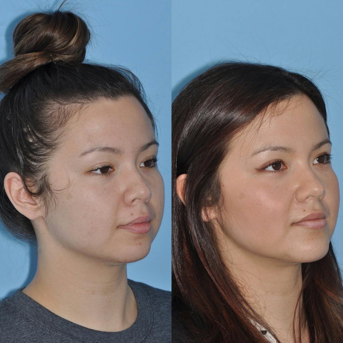 Buccal Fat Excision Before & After Gallery - Patient 165703 - Image 3