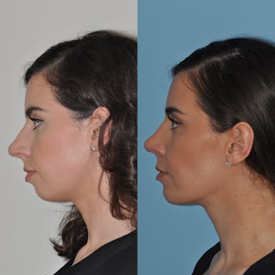 Chin Implants Before & After Gallery - Patient 397385 - Image 1