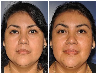 Buccal Fat Excision Before & After Gallery - Patient 106719 - Image 1
