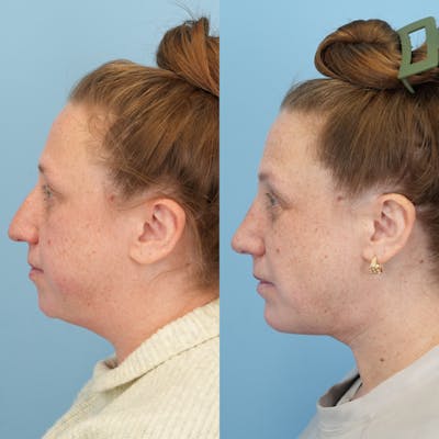 Chin Implants Before & After Gallery - Patient 281484 - Image 1