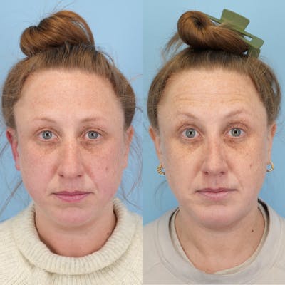 Rhinoplasty Before & After Gallery - Patient 206649 - Image 1