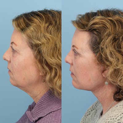 Chin Implants Before & After Gallery - Patient 174209 - Image 1