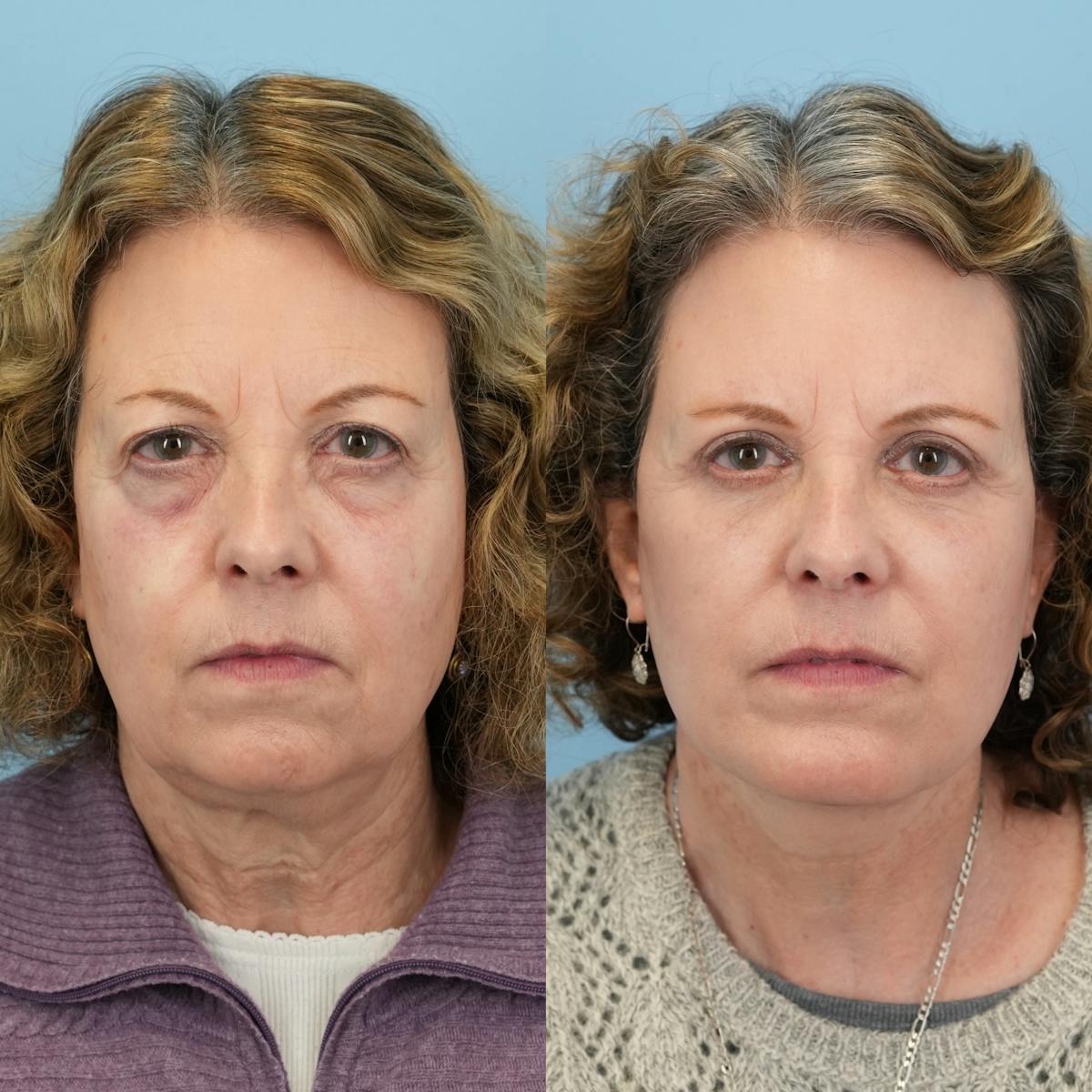 Facelift Before & After Gallery - Patient 406307 - Image 1