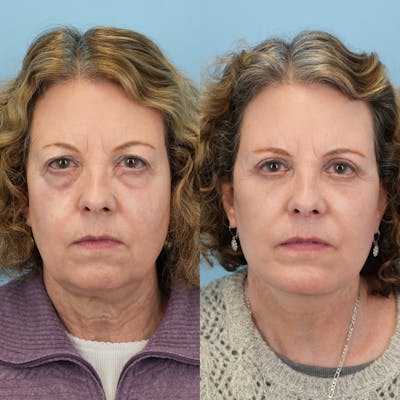 Facelift Before & After Gallery - Patient 406307 - Image 1