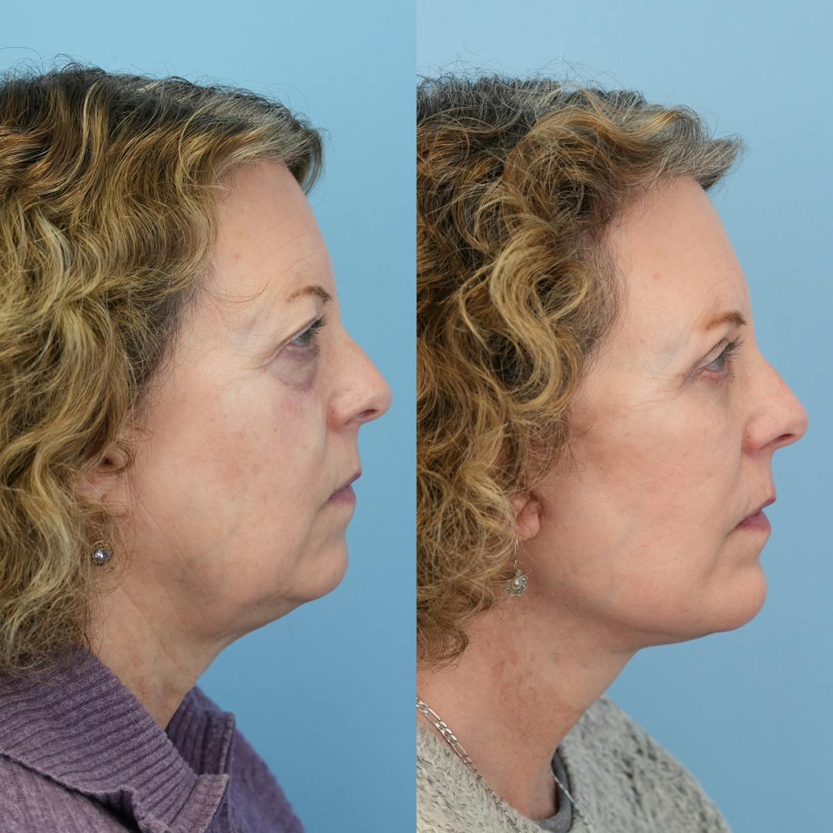Facelift Before & After Gallery - Patient 406307 - Image 3