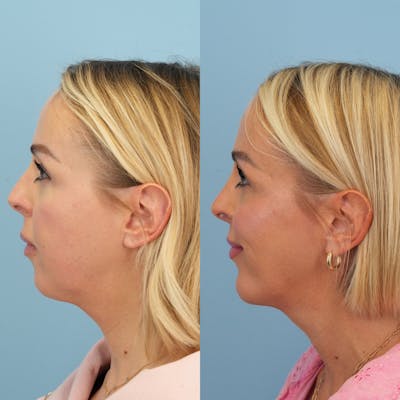 Chin Implants Before & After Gallery - Patient 196779 - Image 1