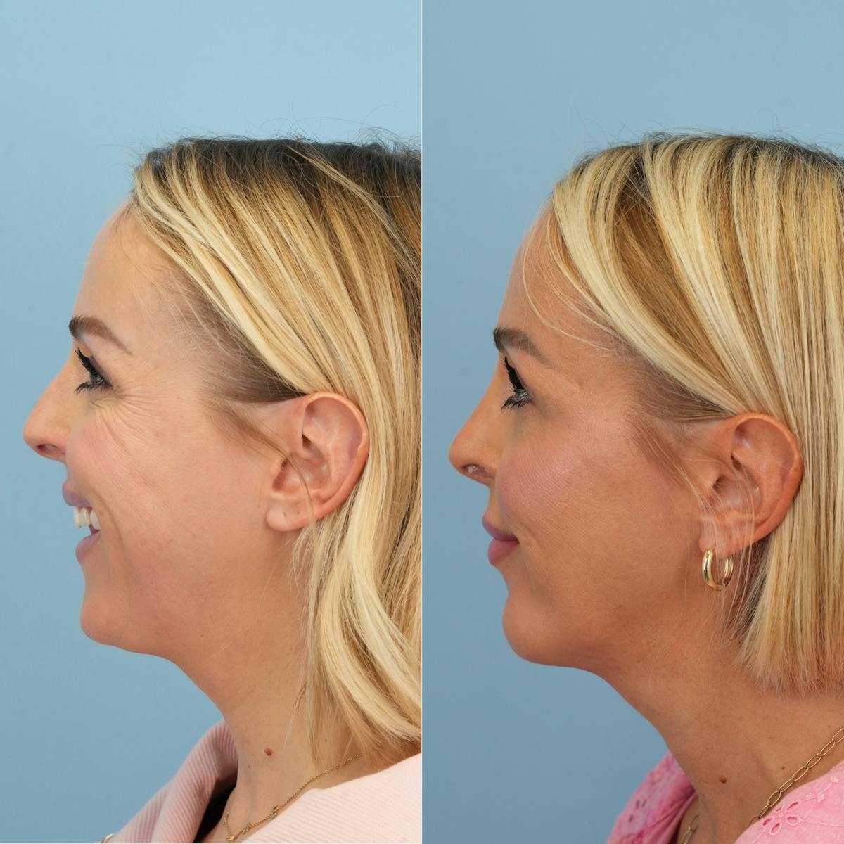 Rhinoplasty Before & After Gallery - Patient 137056 - Image 7