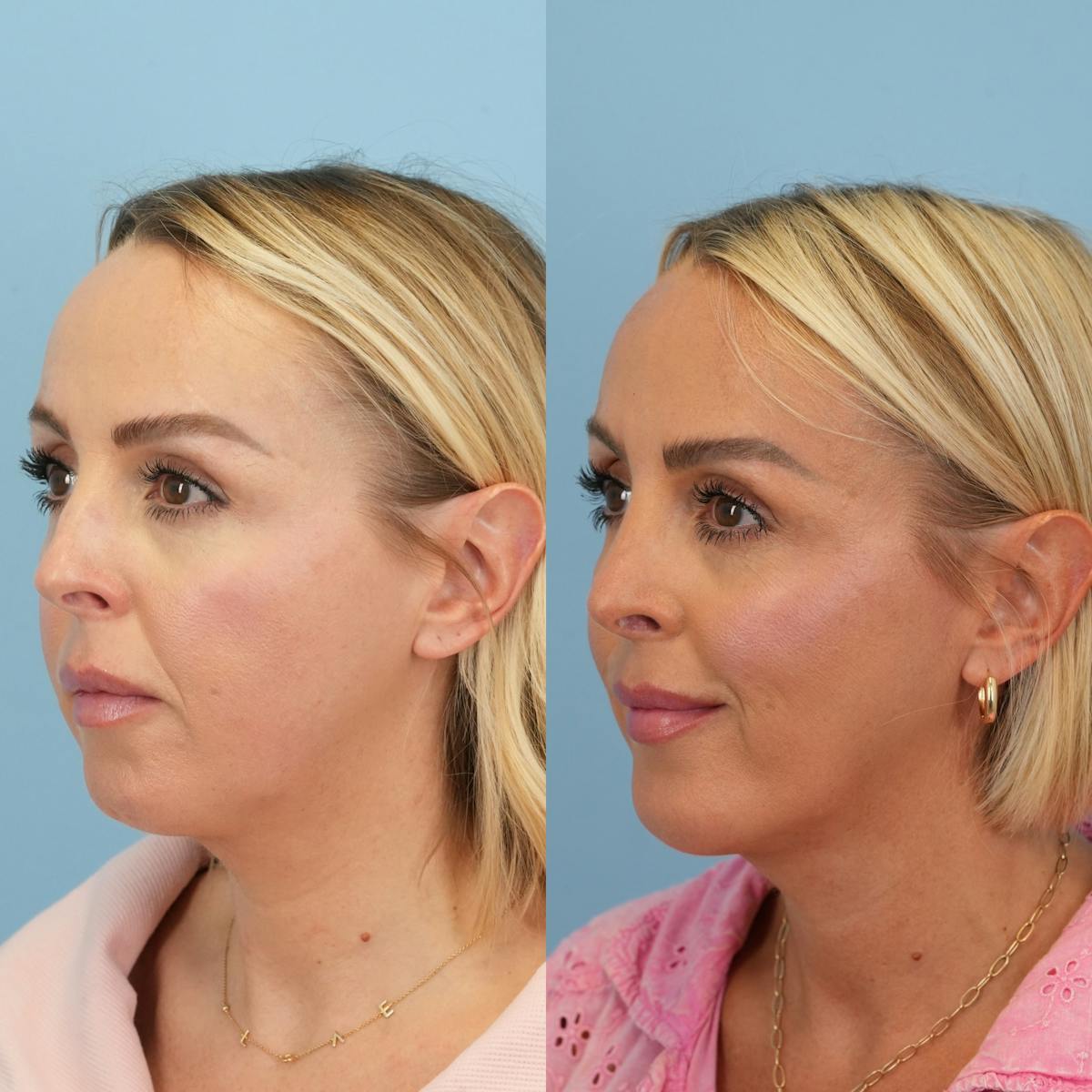 Rhinoplasty Before & After Gallery - Patient 137056 - Image 5